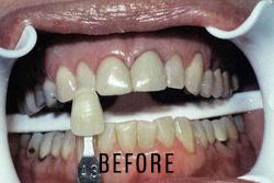 Zoom! Teeth Whitening-01-before