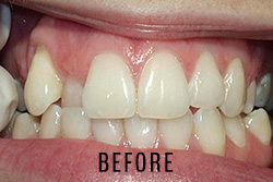 invisalign-01-before