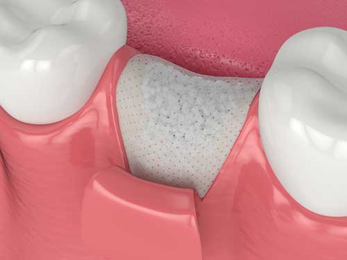 Bone-Grafting-WEB