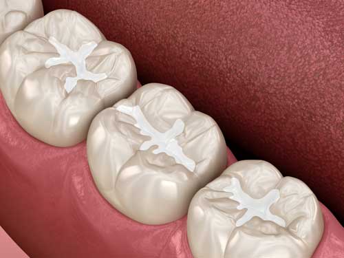 Composite-Fillings_WEB