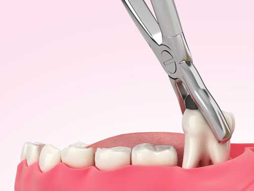Single-tooth-removal-WEB