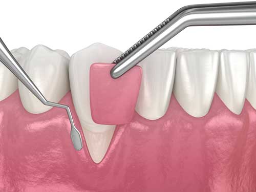 Soft-Tissue-Grafting-WEB