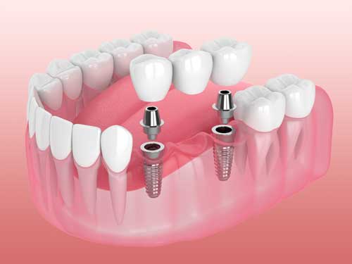 supported-dental-bridge-WEB