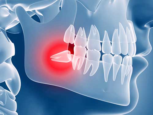 wisdom-tooth--WEB